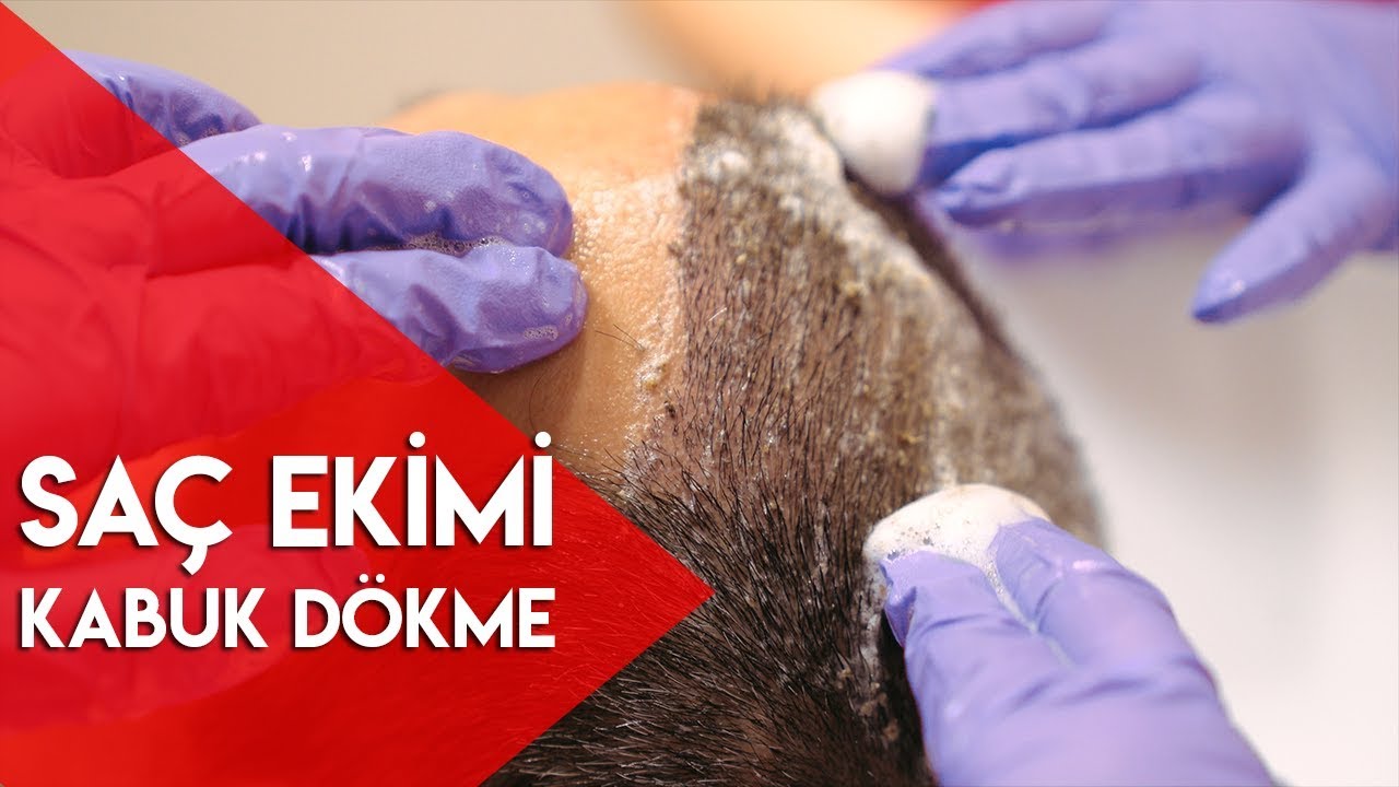 Saç Ekimi Kabuk Dökme Yıkaması